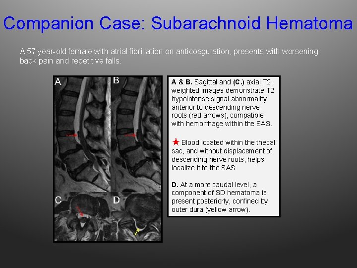 Companion Case: Subarachnoid Hematoma A 57 year-old female with atrial fibrillation on anticoagulation, presents