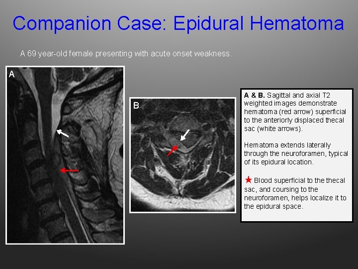Companion Case: Epidural Hematoma A 69 year-old female presenting with acute onset weakness. A