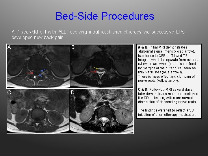 Bed-Side Procedures A 7 year-old girl with ALL receiving intrathecal chemotherapy via successive LPs,