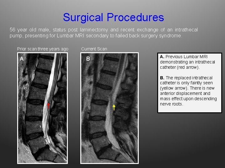 Surgical Procedures 56 year old male, status post laminectomy and recent exchange of an