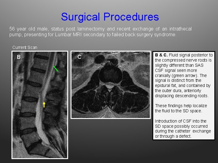 Surgical Procedures 56 year old male, status post laminectomy and recent exchange of an