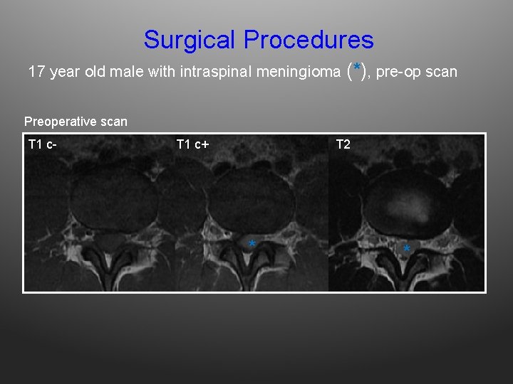 Surgical Procedures 17 year old male with intraspinal meningioma (*), pre-op scan Preoperative scan