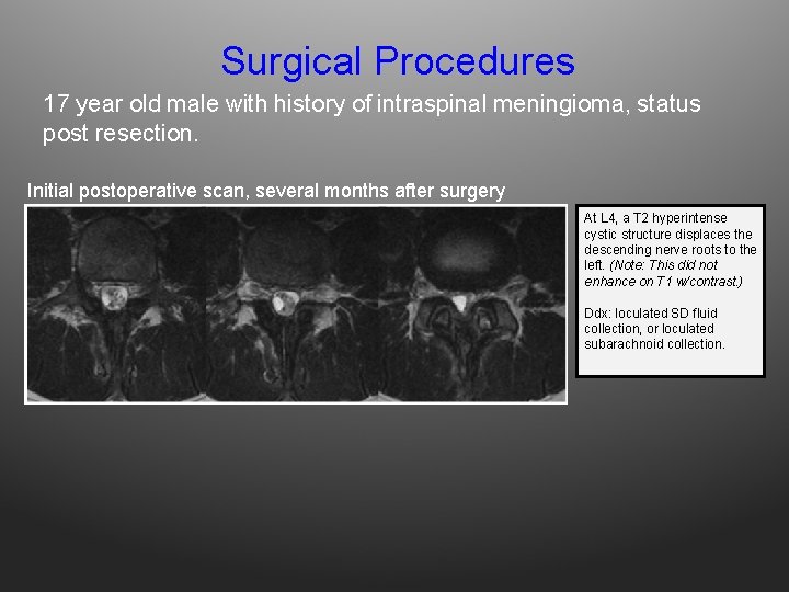 Surgical Procedures 17 year old male with history of intraspinal meningioma, status post resection.