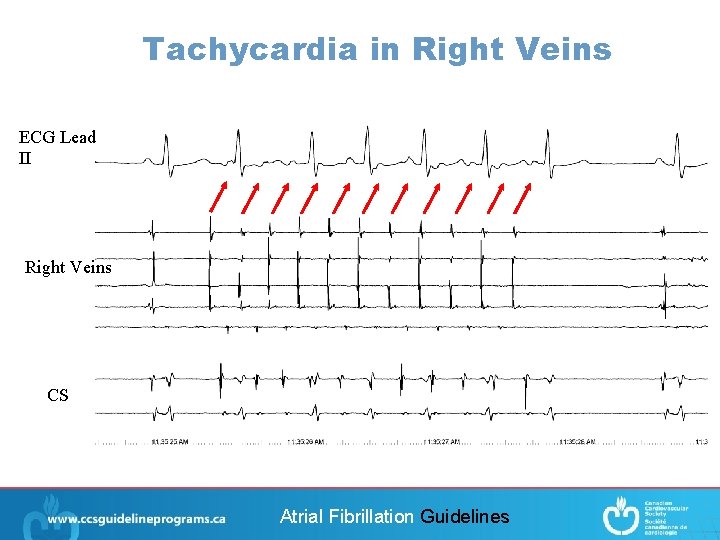 Tachycardia in Right Veins ECG Lead II Right Veins CS Atrial Fibrillation Guidelines 