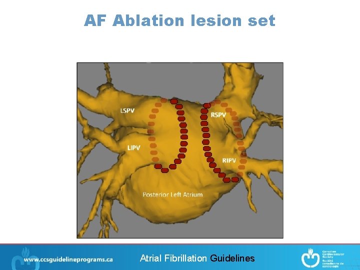 AF Ablation lesion set Atrial Fibrillation Guidelines 