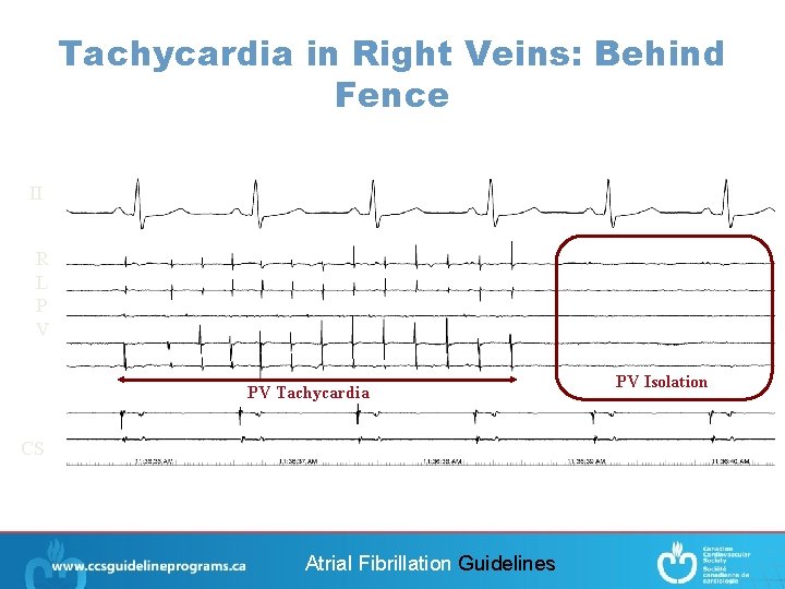 Tachycardia in Right Veins: Behind Fence II R L P V PV Tachycardia CS