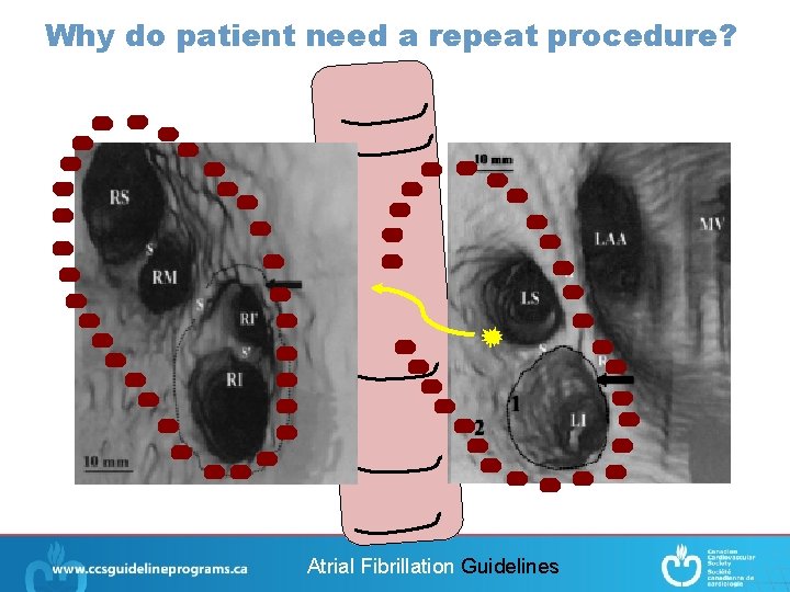 Why do patient need a repeat procedure? Atrial Fibrillation Guidelines 