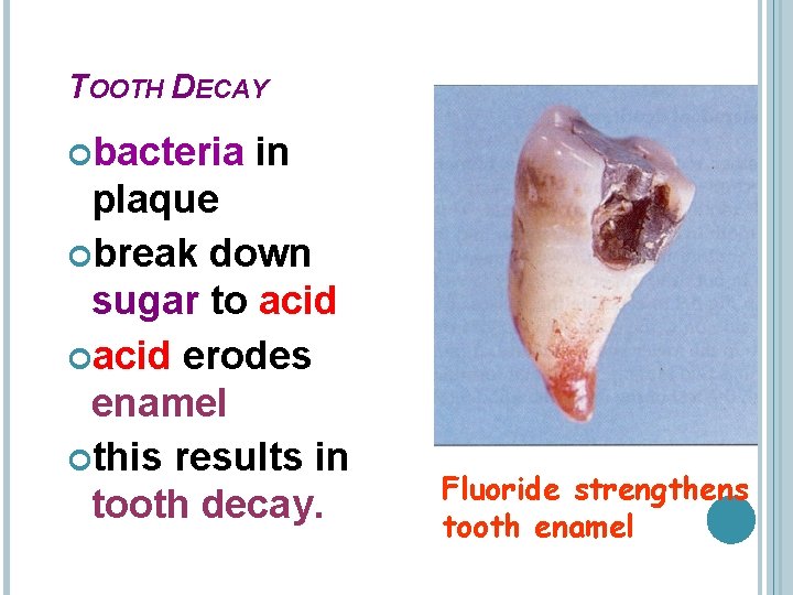 TOOTH DECAY bacteria in plaque break down sugar to acid erodes enamel this results