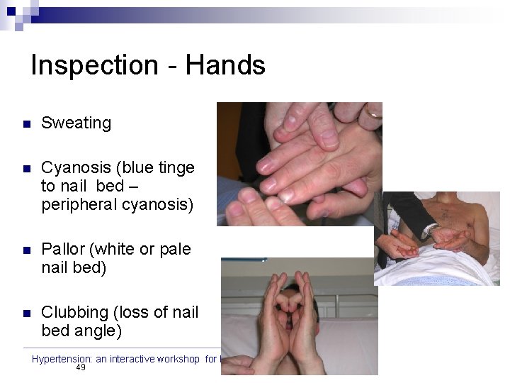 Inspection - Hands n Sweating n Cyanosis (blue tinge to nail bed – peripheral