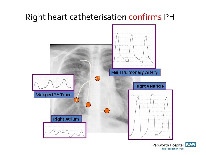 Right heart catheterisation confirms PH Main Pulmonary Artery Right Ventricle Wedged PA Trace Right