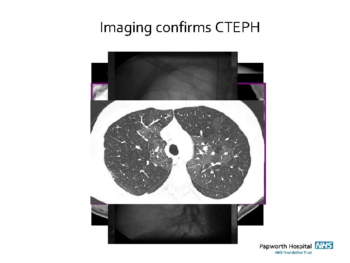 Imaging confirms CTEPH 