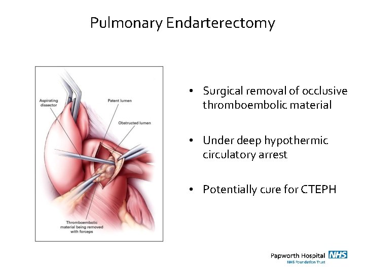 Pulmonary Endarterectomy • Surgical removal of occlusive thromboembolic material • Under deep hypothermic circulatory
