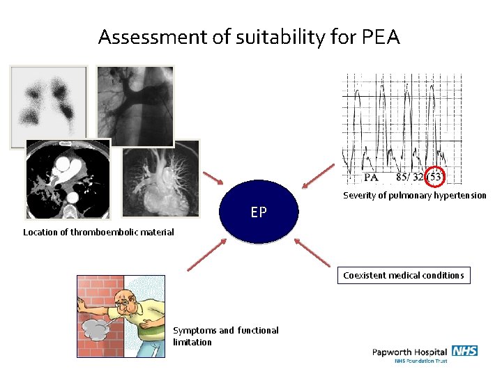 Assessment of suitability for PEA Severity of pulmonary hypertension EP Location of thromboembolic material