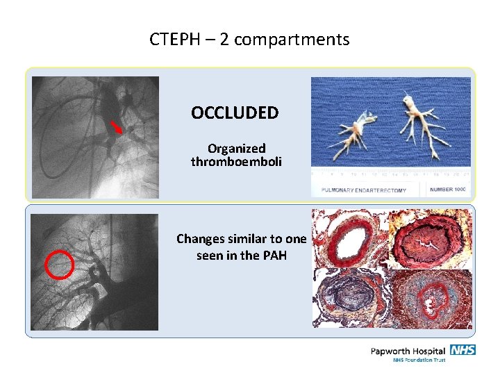 CTEPH – 2 compartments OCCLUDED Organized thromboemboli Changes similar to one seen in the