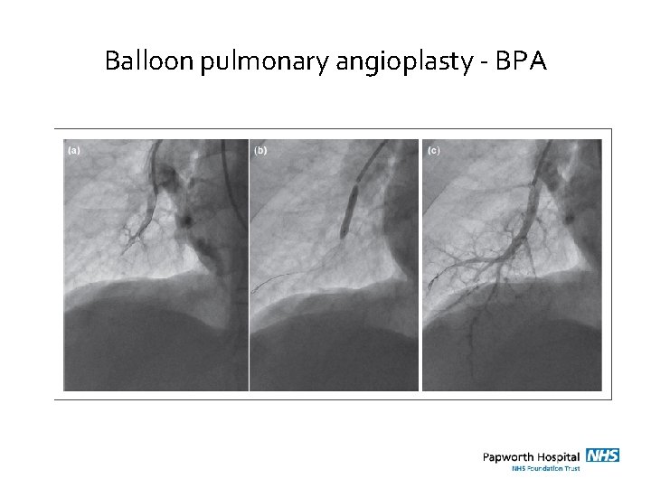 Balloon pulmonary angioplasty - BPA 