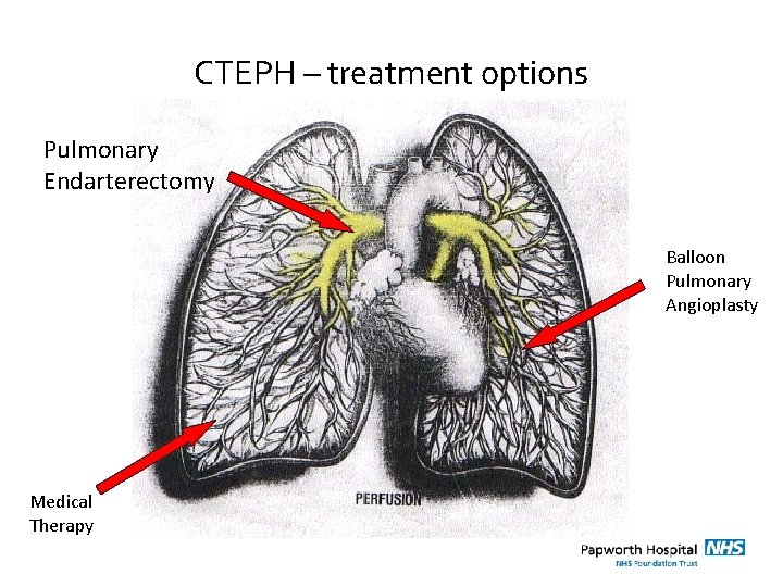 CTEPH – treatment options Pulmonary Endarterectomy Balloon Pulmonary Angioplasty Medical Therapy 