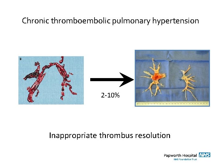 Chronic thromboembolic pulmonary hypertension 2 -10% Inappropriate thrombus resolution 