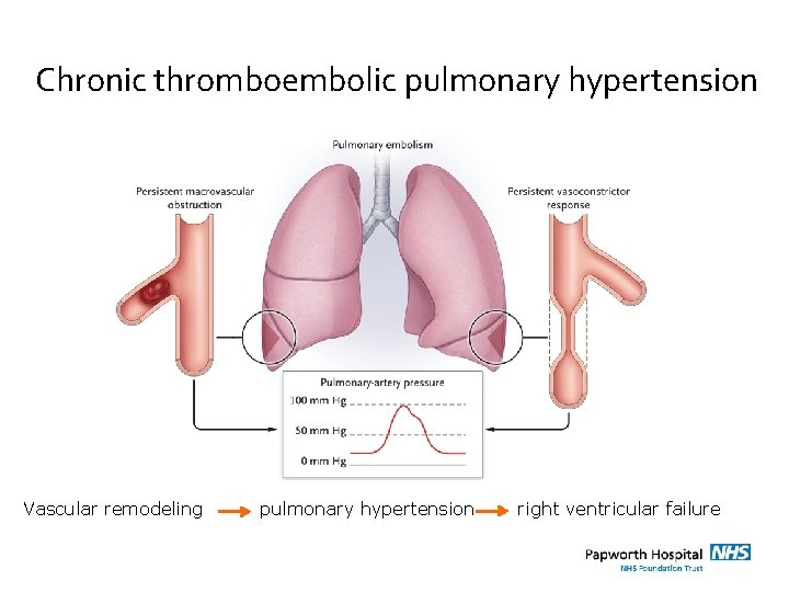 Chronic thromboembolic pulmonary hypertension Vascular remodeling pulmonary hypertension right ventricular failure 