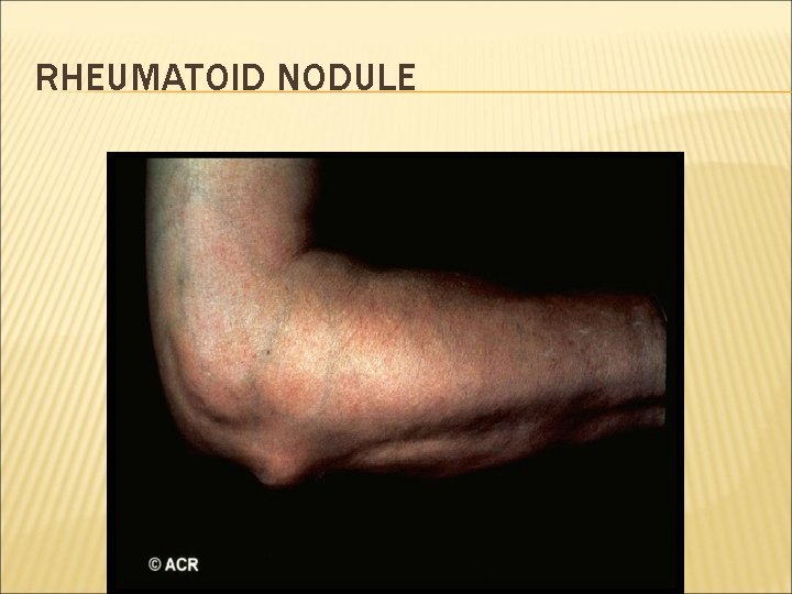 RHEUMATOID NODULE 