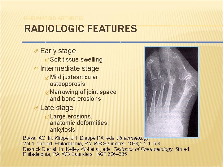 RHEUMATOID ARTHRITIS RADIOLOGIC FEATURES Early stage Soft tissue swelling Intermediate stage Mild juxtaarticular osteoporosis