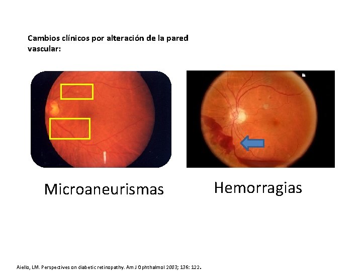 Cambios clínicos por alteración de la pared vascular: Hemorragias Microaneurismas Aiello, LM. Perspectives on