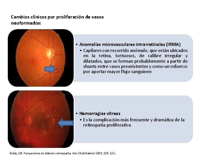 Cambios clínicos por proliferación de vasos neoformados: • Anomalías microvasculares intrarretinales (IRMA) • Capilares