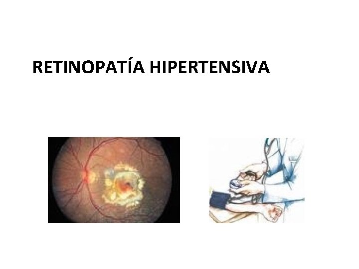 RETINOPATÍA HIPERTENSIVA 