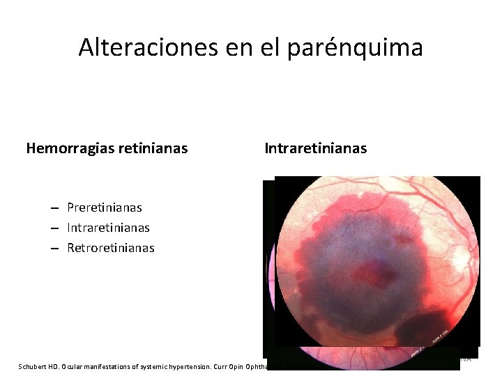 Alteraciones en el parénquima Hemorragias retinianas Intraretinianas – Preretinianas – Intraretinianas – Retroretinianas Schubert