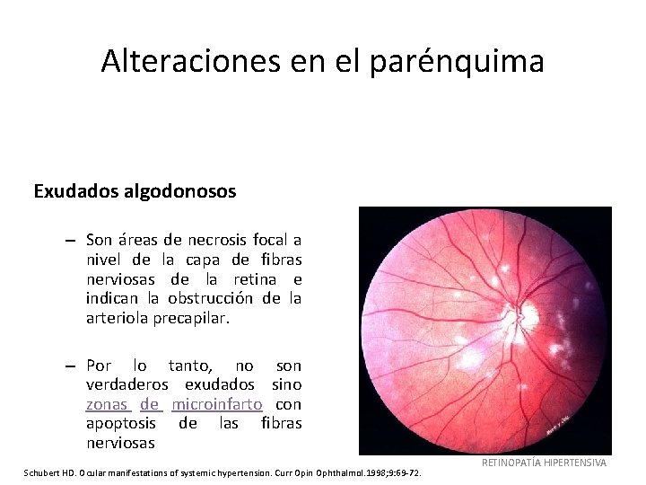 Alteraciones en el parénquima Exudados algodonosos – Son áreas de necrosis focal a nivel