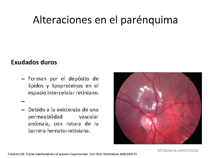 Alteraciones en el parénquima Exudados duros – Forman por el depósito de lípidos y