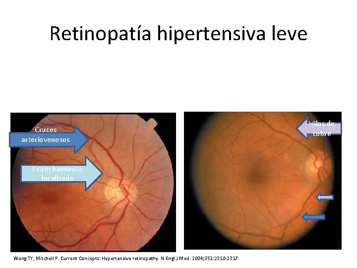 Retinopatía hipertensiva leve Cruces arteriovenosos Estrechamiento localizado Wong TY, Mitchell P. Current Concepts: Hypertensive