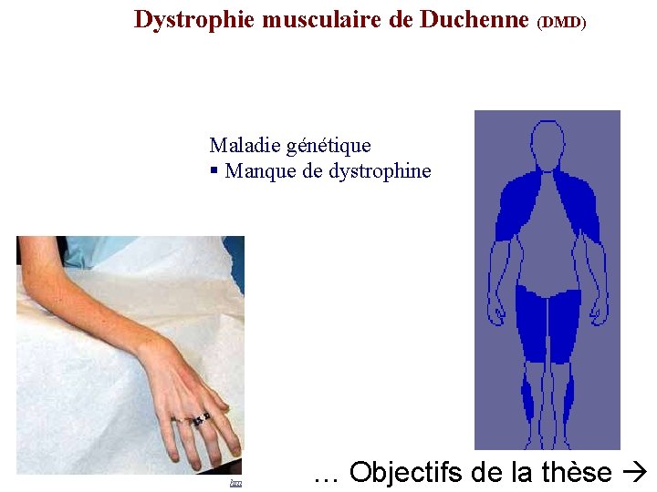 Dystrophie musculaire de Duchenne (DMD) Maladie génétique § Manque de dystrophine … Objectifs de.