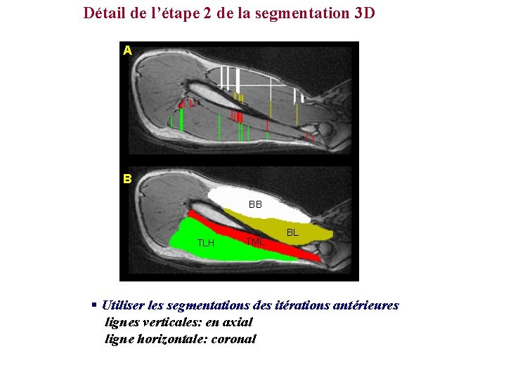 Détail de l’étape 2 de la segmentation 3 D A B BB TLH TML