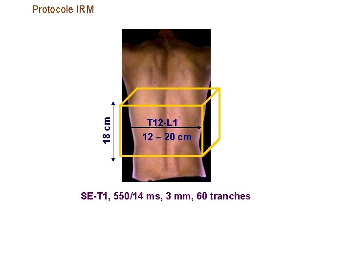 18 cm Protocole IRM T 12 -L 1 12 – 20 cm SE-T 1,