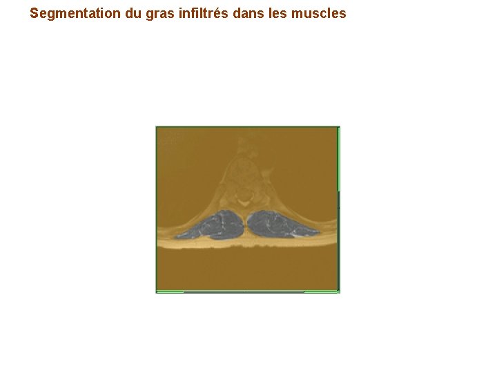 Segmentation du gras infiltrés dans les muscles 