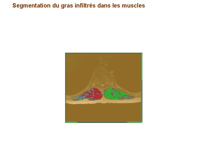 Segmentation du gras infiltrés dans les muscles 