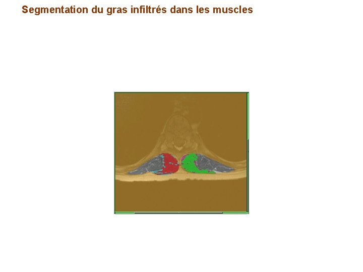 Segmentation du gras infiltrés dans les muscles 