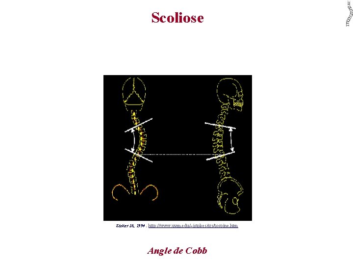 Scoliose Stokes IA, 1994 : http: //www. uvm. edu/~istokes/srs/tospine. htm Angle de Cobb 