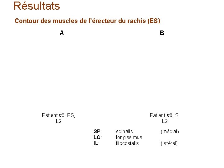 Résultats Contour des muscles de l’érecteur du rachis (ES) A B Patient #6, PS,