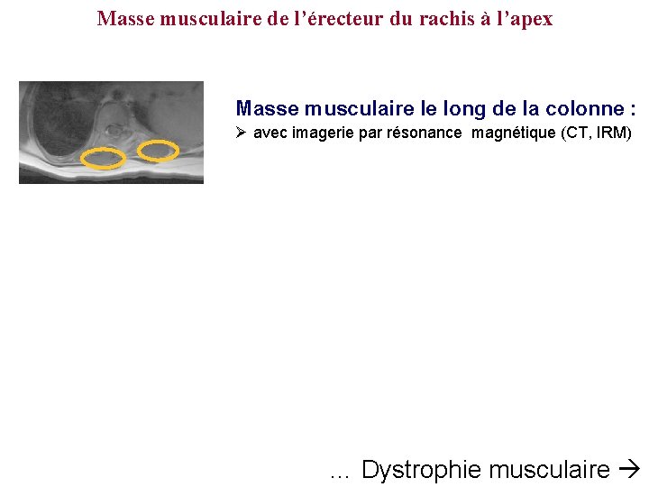 Masse musculaire de l’érecteur du rachis à l’apex Masse musculaire le long de la