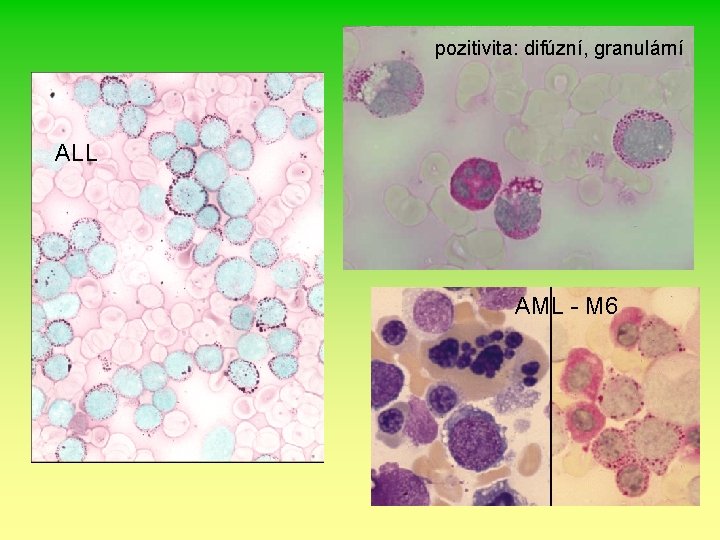 pozitivita: difúzní, granulární ALL AML - M 6 