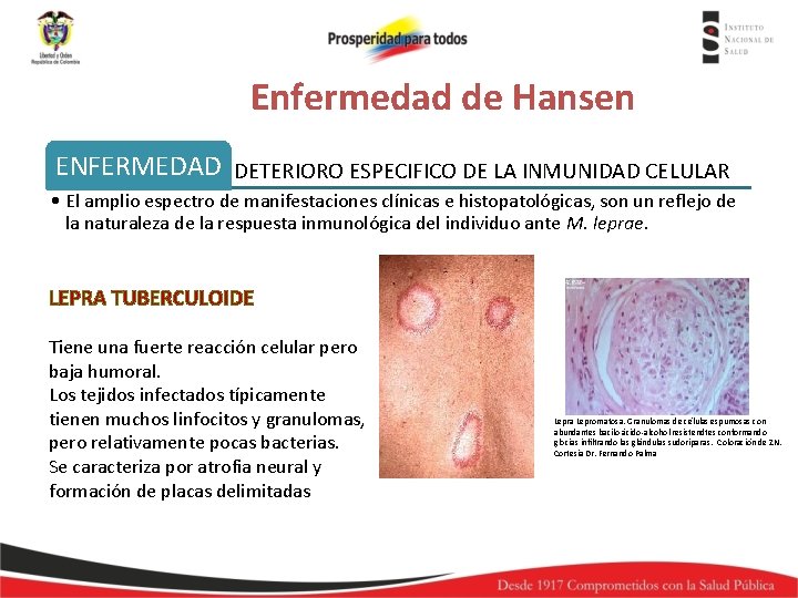 Enfermedad de Hansen ENFERMEDAD DETERIORO ESPECIFICO DE LA INMUNIDAD CELULAR • El amplio espectro