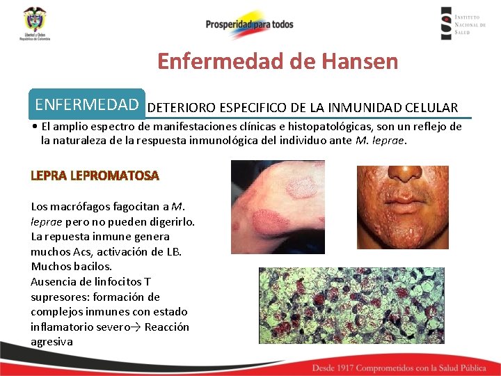 Enfermedad de Hansen ENFERMEDAD DETERIORO ESPECIFICO DE LA INMUNIDAD CELULAR • El amplio espectro