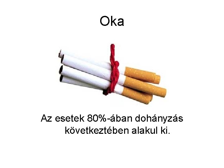 Oka Az esetek 80%-ában dohányzás következtében alakul ki. 