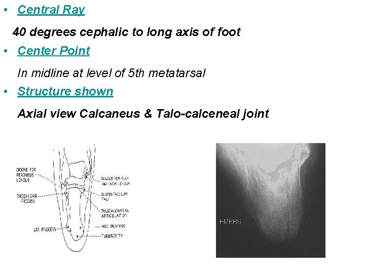  • Central Ray 40 degrees cephalic to long axis of foot • Center