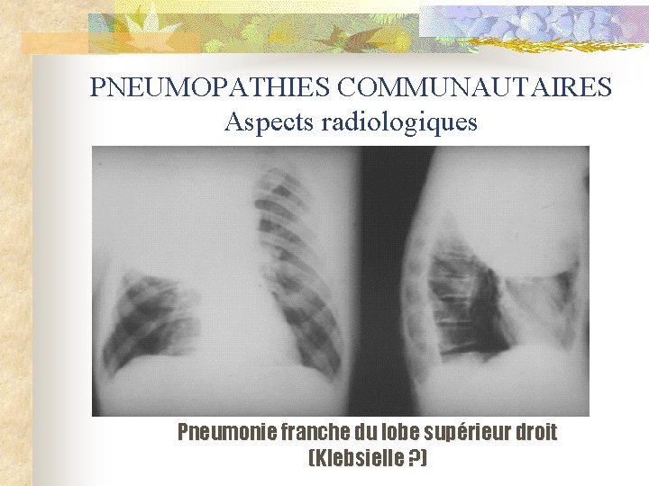 PNEUMOPATHIES COMMUNAUTAIRES Aspects radiologiques Pneumonie franche du lobe supérieur droit (Klebsielle ? ) 