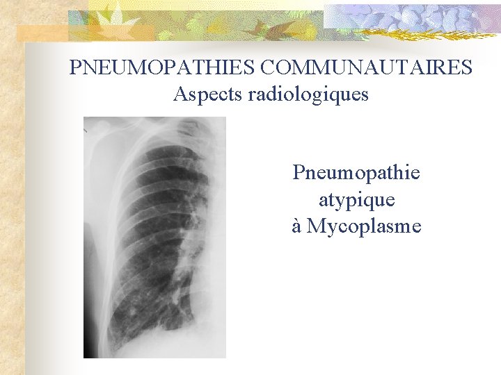 PNEUMOPATHIES COMMUNAUTAIRES Aspects radiologiques Pneumopathie atypique à Mycoplasme 