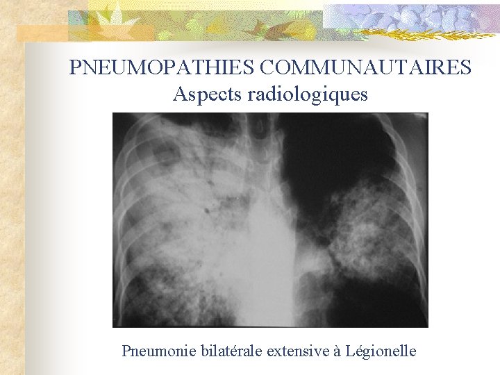 PNEUMOPATHIES COMMUNAUTAIRES Aspects radiologiques Pneumonie bilatérale extensive à Légionelle 