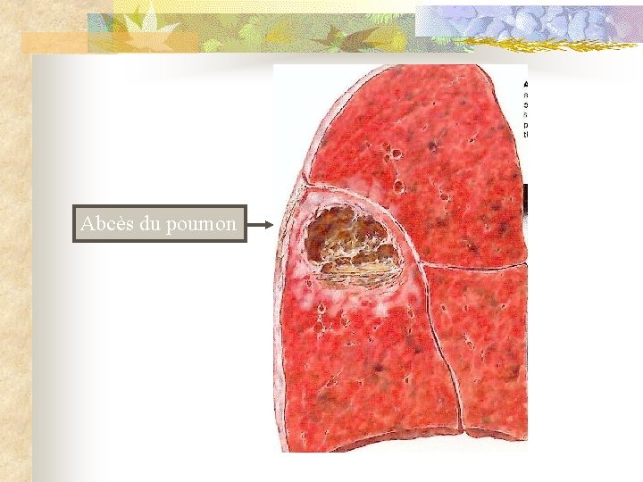 Abcès du poumon 