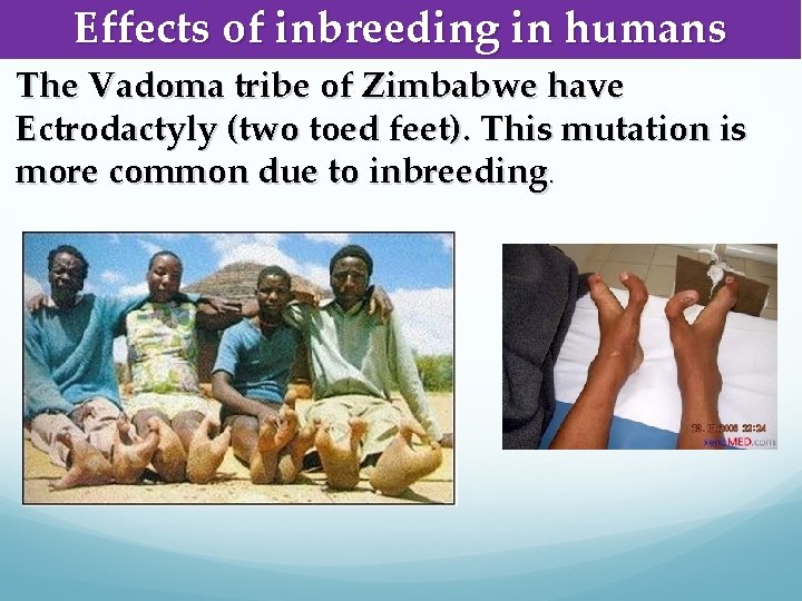 Effects of inbreeding in humans The Vadoma tribe of Zimbabwe have Ectrodactyly (two toed